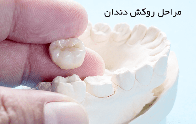 مراحل قرار دادن روکش دندان