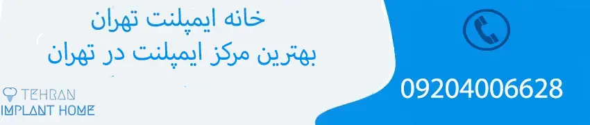 بهترین مرکز ایمپلنت دیجیتال در تهران کجاست؟