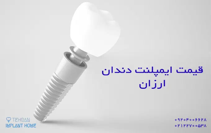 قیمت ایمپلنت ارزان چقدر است؟