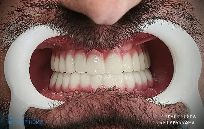 بهترین کلینیک برای روکش دندان در تهران