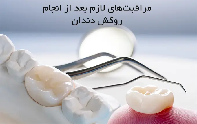 مراقبت‌های لازم بعد از انجام روکش دندان