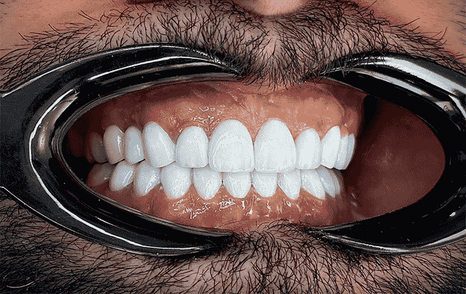 هزینه لمینت دندان چگونه تعیین می‌شود؟