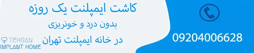 مزایای ایمپلنت فوری در تهران