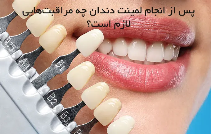 مراقبت‌های بعد از لمینت دندان