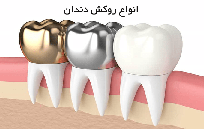 انواع روکش دندان