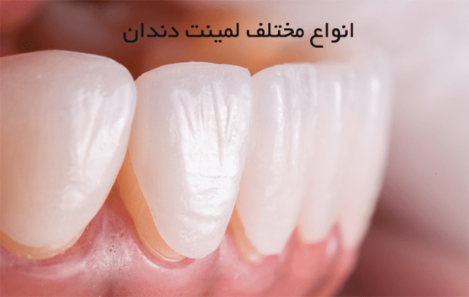 معرفی انواع  لمینت دندان