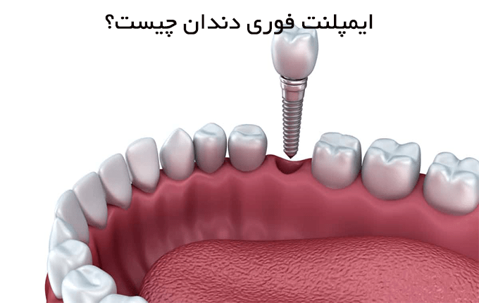 ایمپلنت فوری دندان چیست؟
