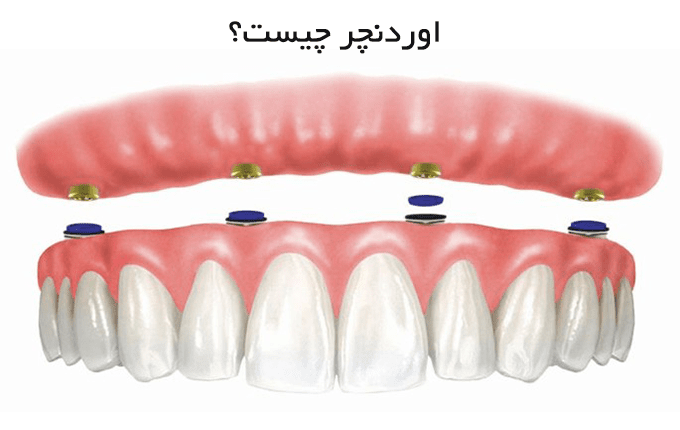 اوردنچر چیست؟