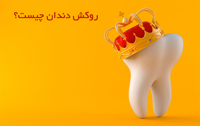 روکش دندان چیست؟