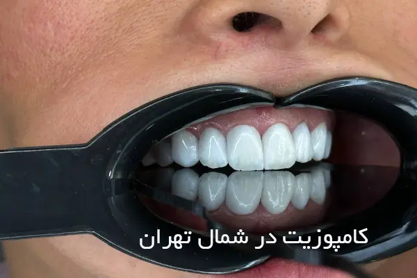 چگونه متخصص خوب کامپوزیت در شمال تهران پیدا کنیم؟ 