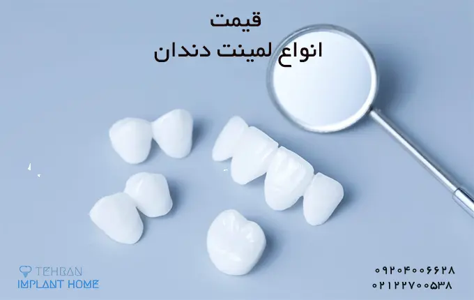 قیمت لمینت دندان چگونه محاسبه می شود؟