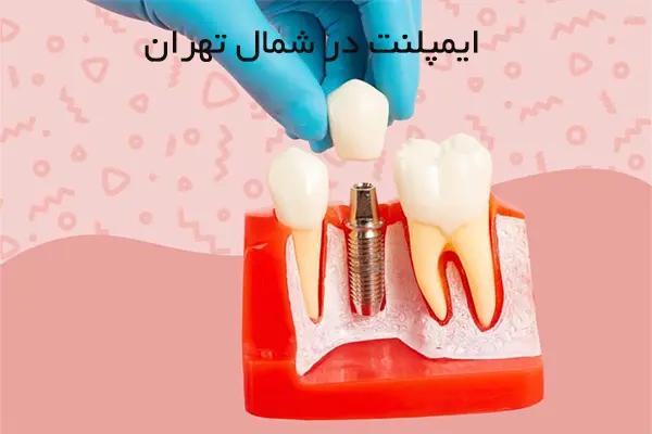 ویژگی‌های بهترین مرکز ایمپلنت در شمال تهران