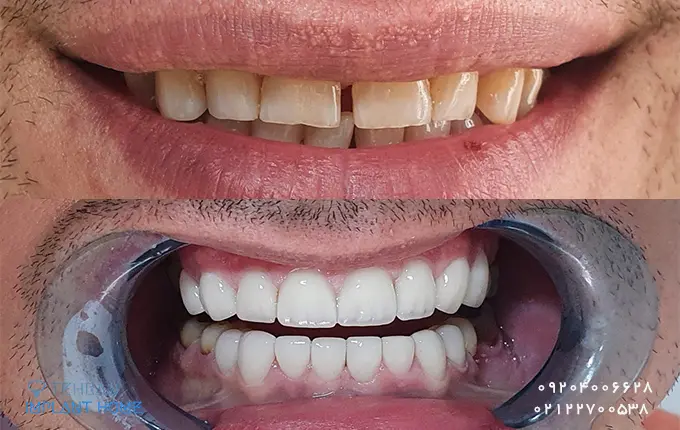 نکاتی برای انتخاب بهترین متخصص لمینت در شمال تهران