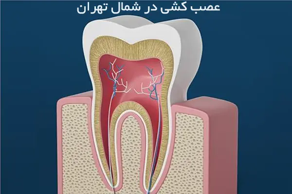 بهترین دکترعصب کشی در شمال تهران