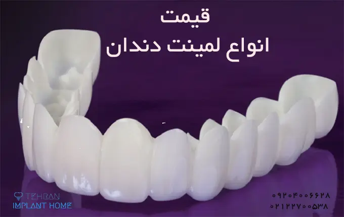 قیمت انواع لمینت دندان