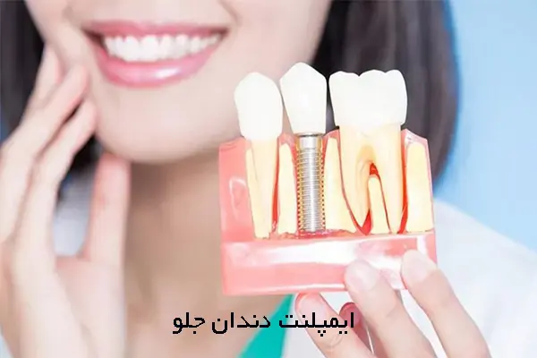 ایمپلنت دندان جلو چیست؟