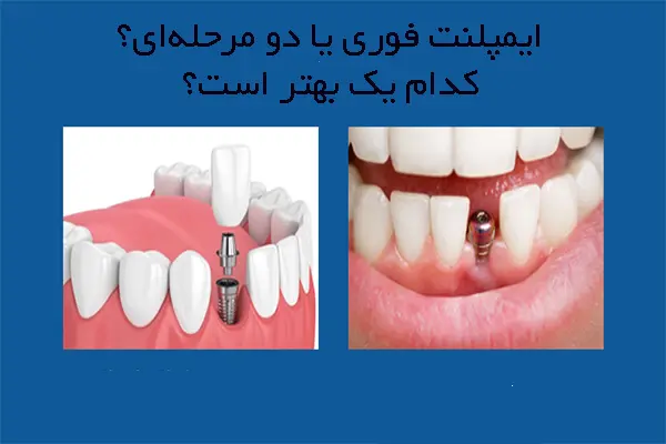 ایمپلنت فوری بهتر است یا ایمپلنت معمولی