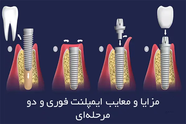 کدام روش برای شما مناسب‌تر است؟ کاشت دندان یک روزه یا دو مرحله‌ای؟