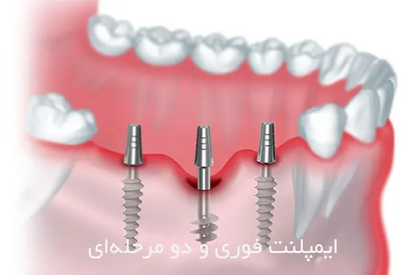 مقایسه ایمپلنت فوری و دو مرحله‌ای