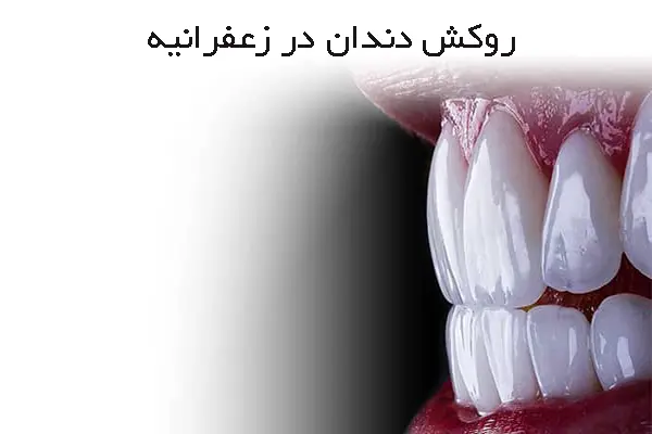 اخذ نوبت آنلاین از متخصص روکش دندان در زعفرانیه تهران
