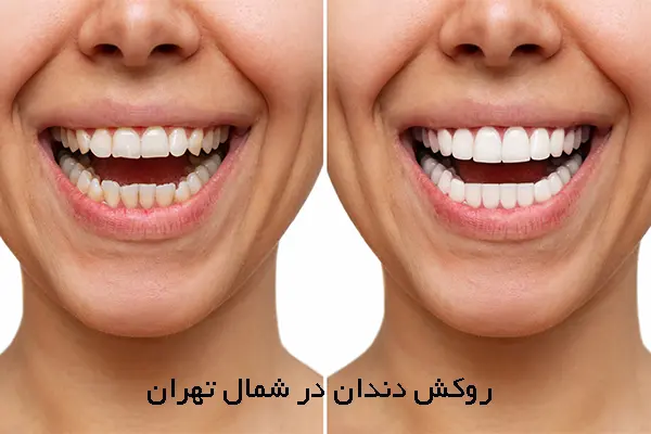 لیست بهترین متخصصان روکش دندان در شمال تهران
