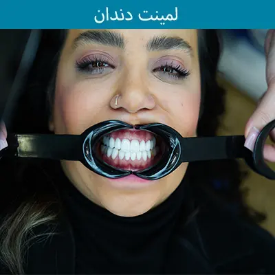 عکس قبل و بعد لمینت دندان