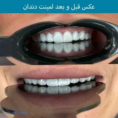 عکس لمینت دندان قبل و بعد