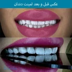 عکس لمینت دندان قبل و بعد