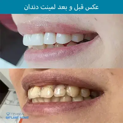 عکس لمینت دندان قبل و بعد