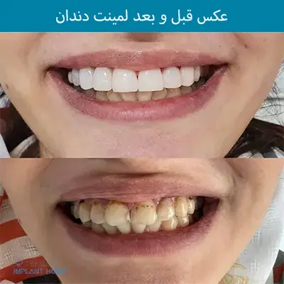 عکس لمینت دندان قبل و بعد