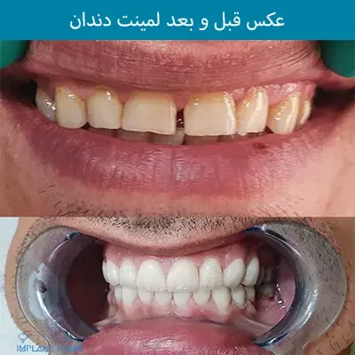 عکس لمینت دندان قبل و بعد