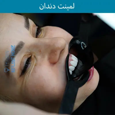قبل و بعد لمینت در زعفرانیه