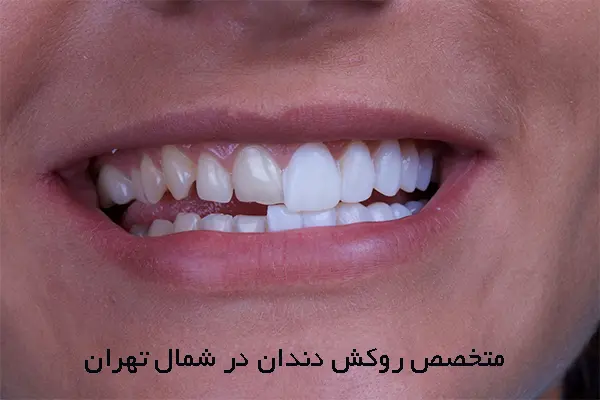 چرا به متخصص روکش دندان نیاز داریم؟