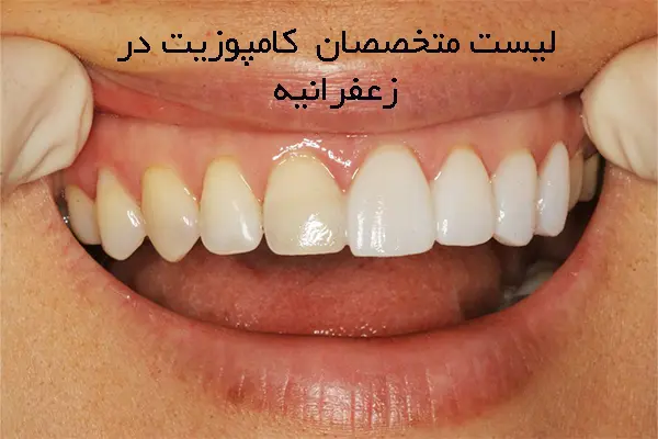 بهترین دندانپزشکان کامپوزیت در زعفرانیه