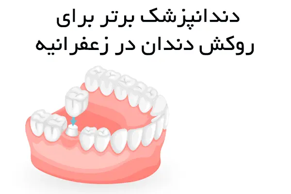 ۱۰ دندانپزشک برتر روکش دندان در زعفرانیه