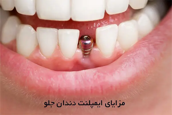مزایای ایمپلنت دندان جلو