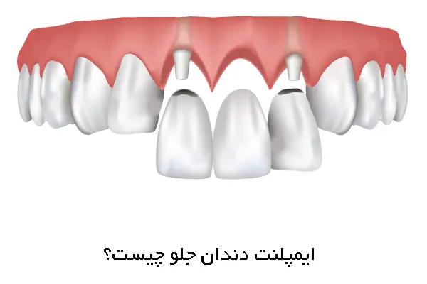 ایمپلنت دندان جلو