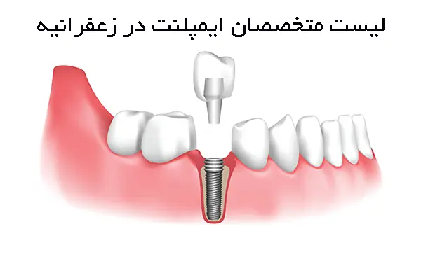 بهترین متخصصان ایمپلنت در زعفرانیه