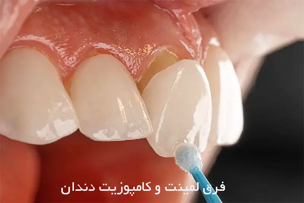مزایای استفاده از لمینت و کامپوزیت دندان 