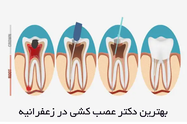 بهترین دکتر عصب کشی در زعفرانیه کیست؟ 