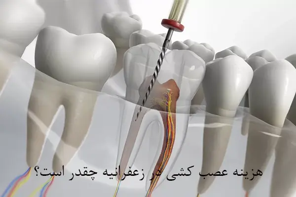 هزینه عصب کشی در زعفرانیه