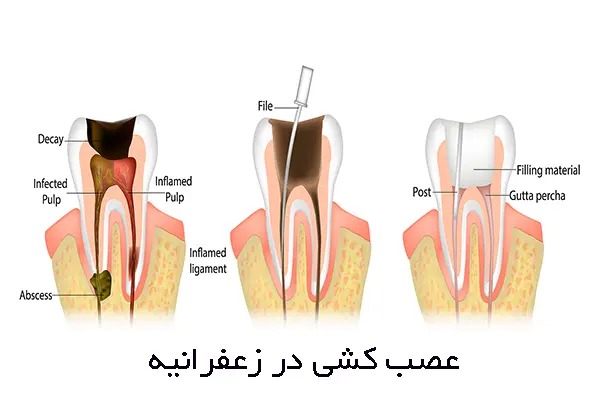 معرفی متخصصان عصب کشی در زعفرانیه