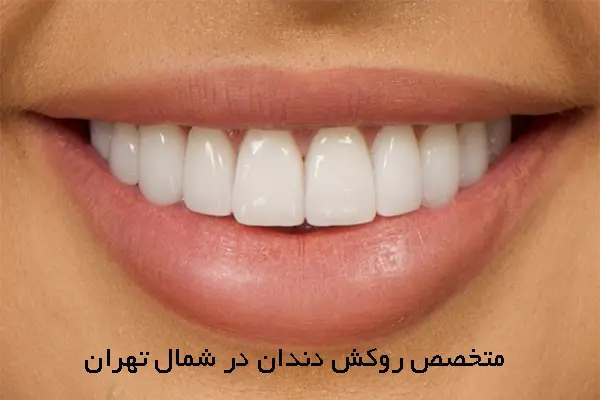 چرا متخصص روکش دندان در شمال تهران؟