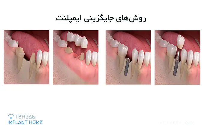 روش کاشت دندان بدون ایمپلنت با تکنولوژی جدید