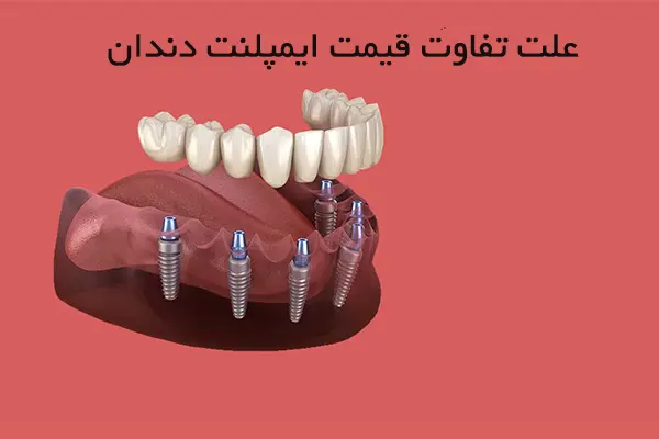 10 علت تفاوت قیمت ایمپلنت دندان