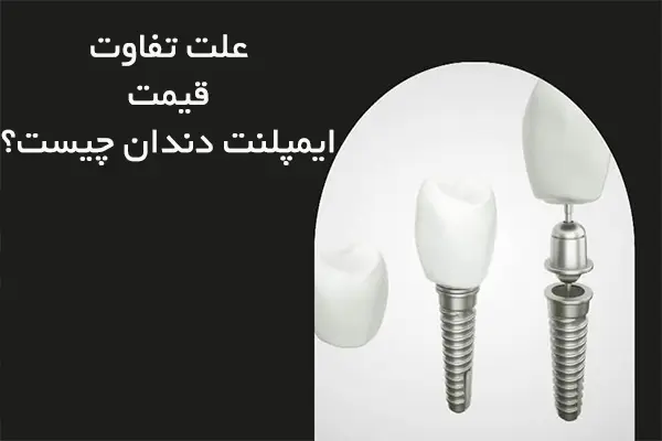 10 علت تفاوت قیمت ایمپلنت دندان