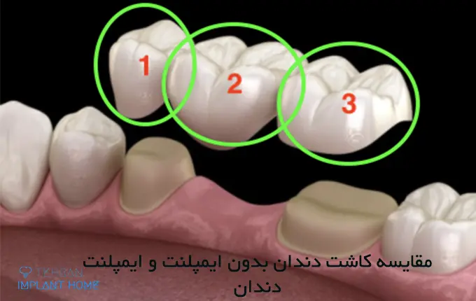 مزایا و معایب کاشت دندان بدون ایمپلنت