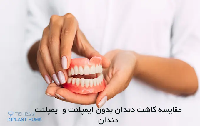 کاشت دندان بدون ایمپلنت