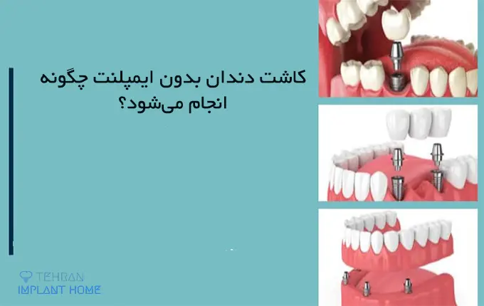 مقایسه کاشت دندان بدون ایمپلنت و ایمپلنت دندان