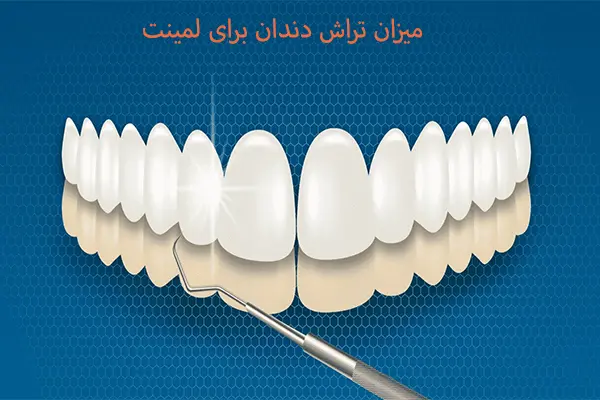 نحوه تراش دندان برای لمینت